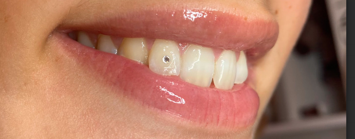 TOOTH-GEMS-MENORCA-.