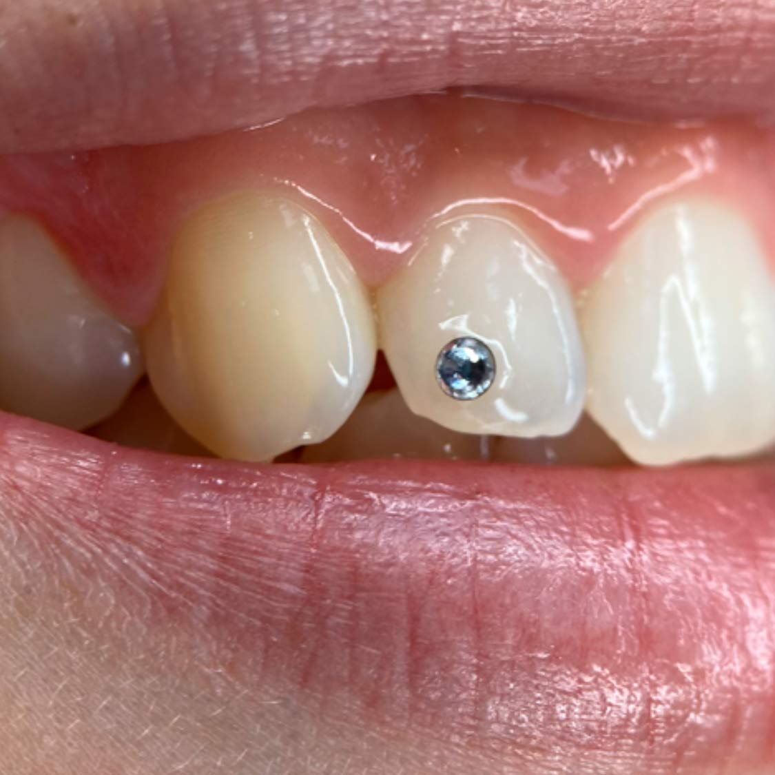 brillo-en-dientes-alicante