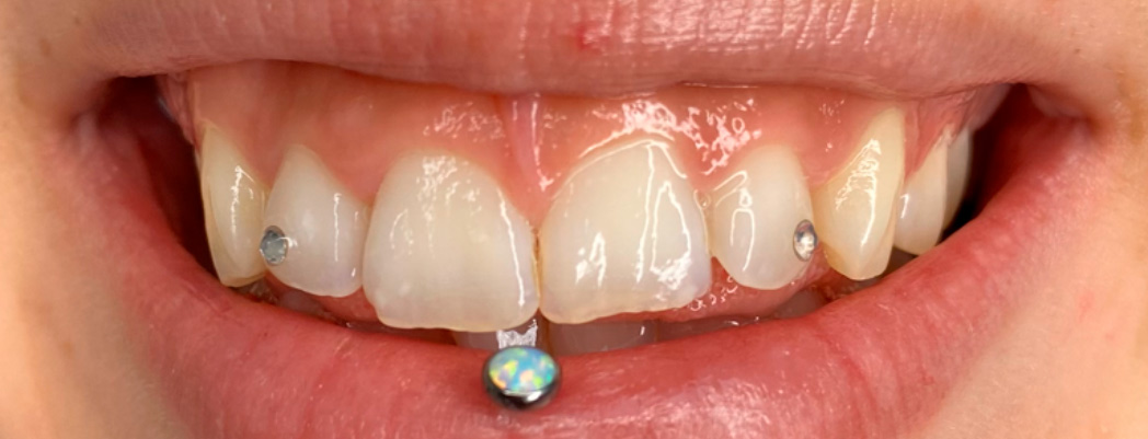 joyas-dentales-en-alicante