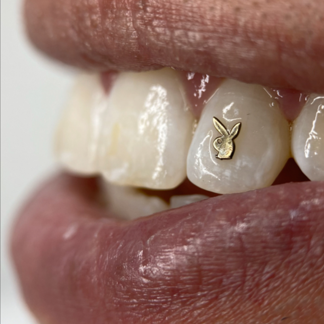 tooth-gems-alicante