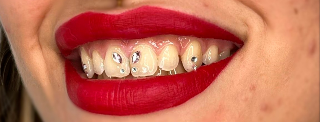tooth-gems-murcia